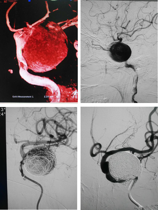 巨大脑动脉瘤覆膜支架治疗手术