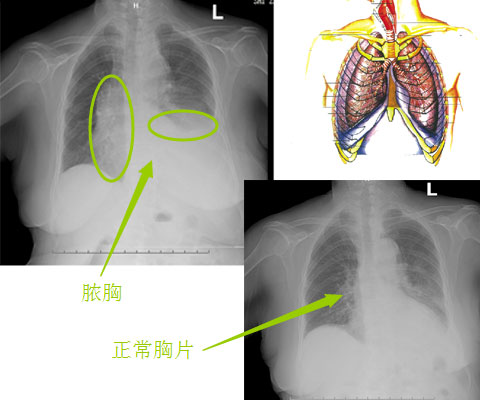       脓胸