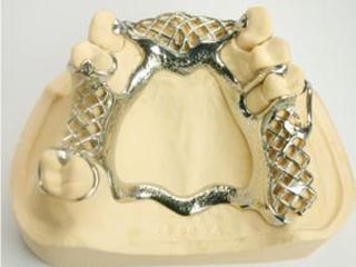 可摘局部义齿铸造活动支架