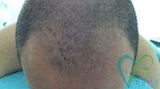 毛发移植手术过程