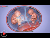 双胞胎宫内抢血可致死
双胎妊娠需定期产检