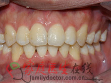 牙齿矫正前后对比-治疗后正面