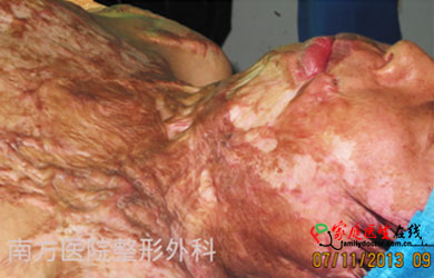 天津爆炸烧伤无数 烧伤后如何预防增生性瘢痕