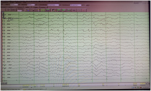 脑电图正常但是抽搐图片