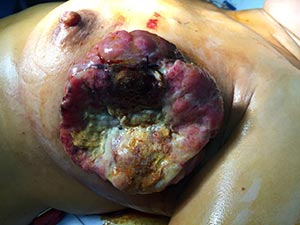 乳腺照片恶性肿瘤图片