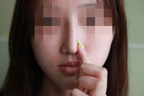 美女花4万做异体肋软骨隆鼻 鼻子反复发炎刺痛