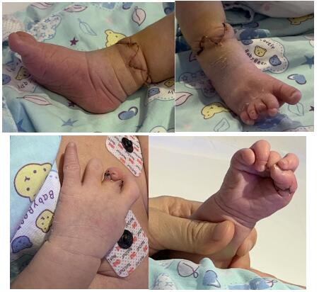新生儿束带综合症图片图片