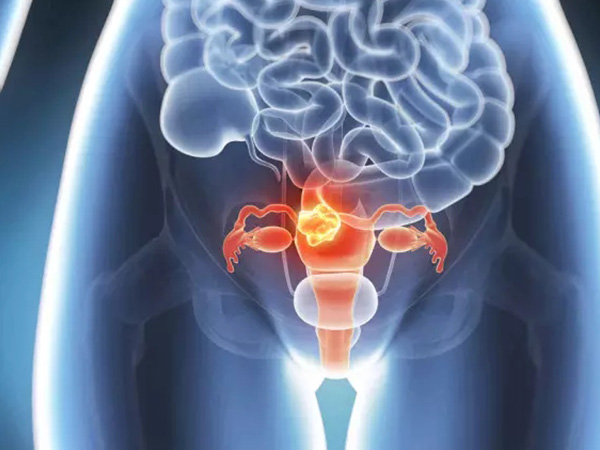 多囊卵巢孕期更容易发生胎停