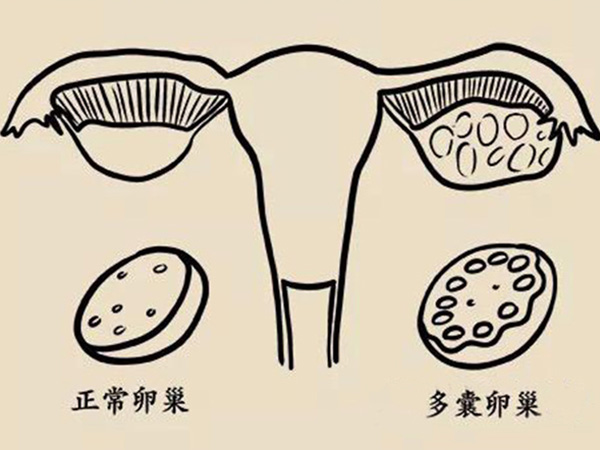 多囊患者在孕期要注意补充雌激素