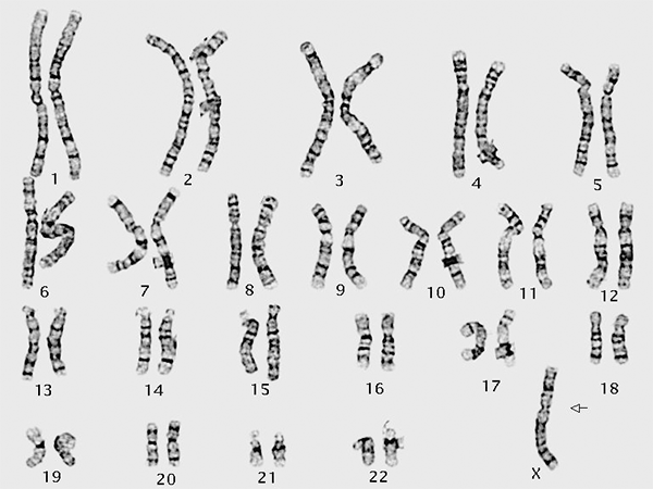 染色体异常排列图