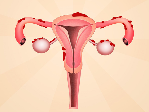 短方案适合卵巢功能低的患者