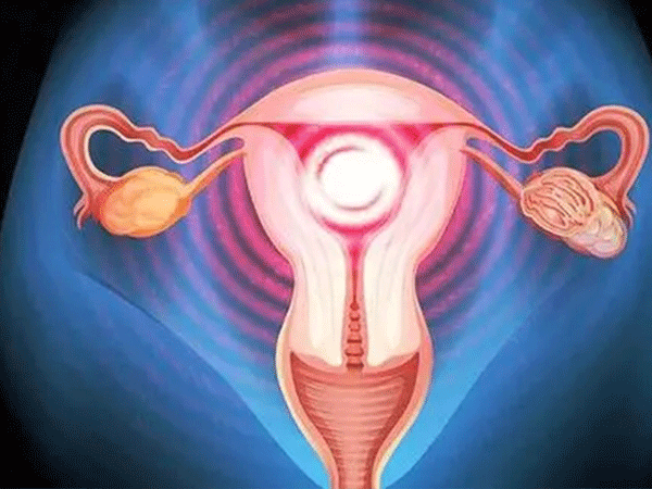 子宫内膜异位症有复发可能