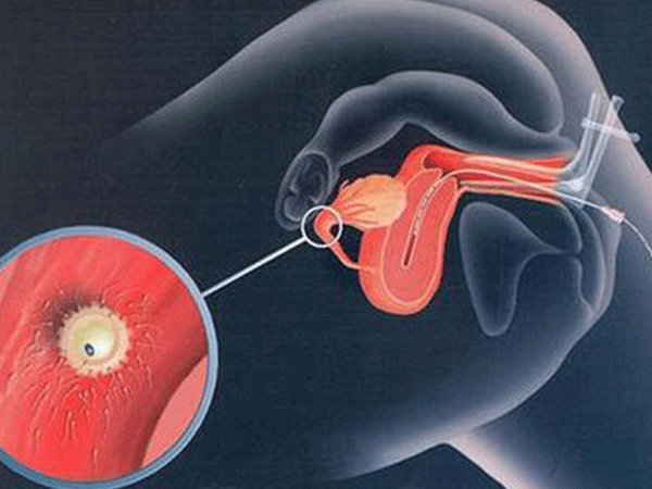 移植囊胚要看月经周期