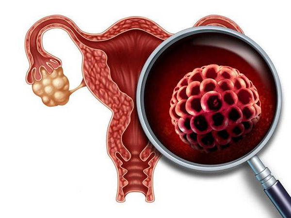 多囊卵巢会造成持续强阳