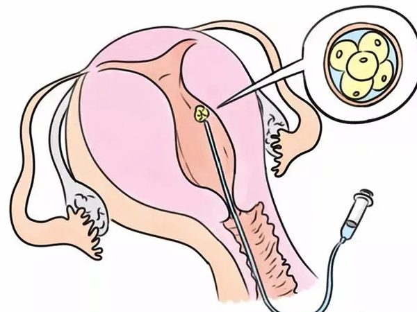 轻度腹水可以进行囊胚移植