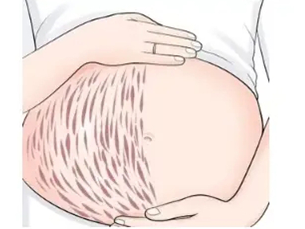 妊娠纹在肚脐下方不一定生女儿