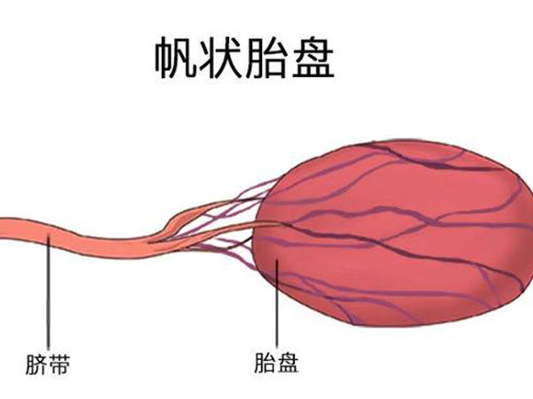 帆状胎盘可以选择顺产