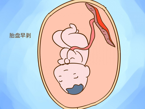 孕期发现胎盘早剥可能对孩子智力有损害