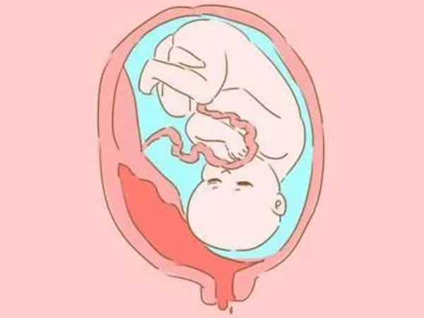 孕期发现胎盘早剥应及时治疗