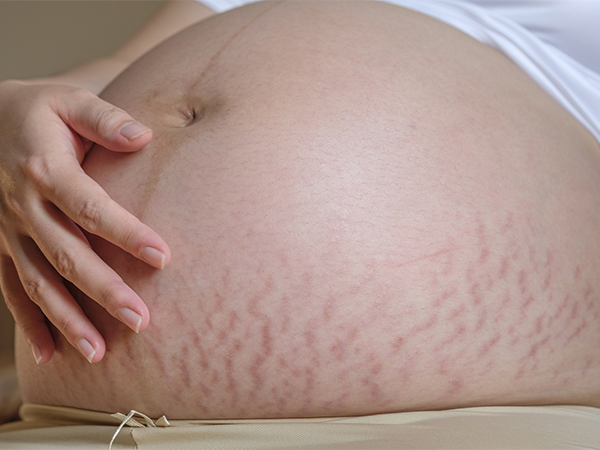 孕晚期妊娠纹通常为暗红色