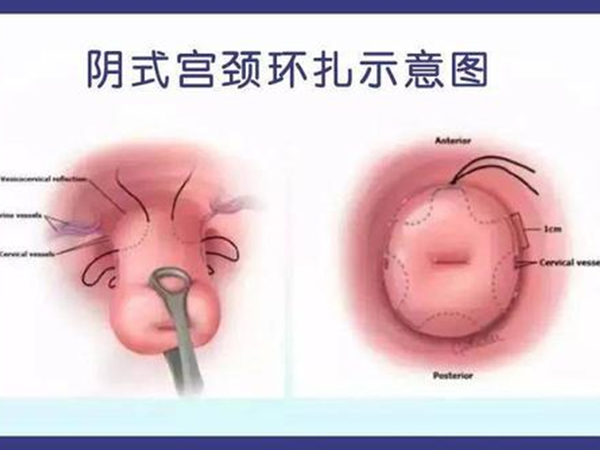 环扎手术用于孕期宫颈过短