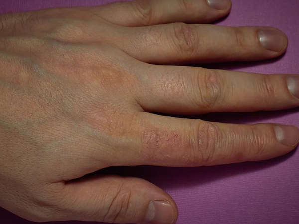 孕34周早晨起床手指有轻微的肿胀感是什么原因?