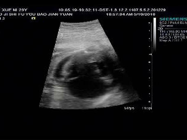 孕22周三尖瓣反流、肺动脉瓣增厚需要做什么检查？