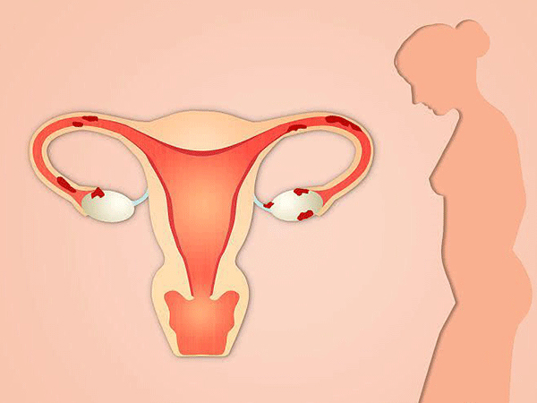 多囊卵巢会导致月经不调