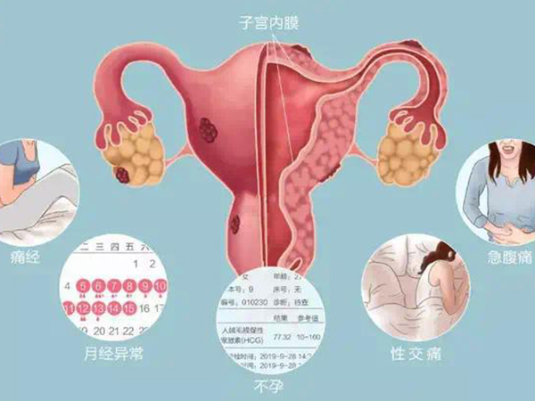子宫内膜息肉是会影响怀孕的