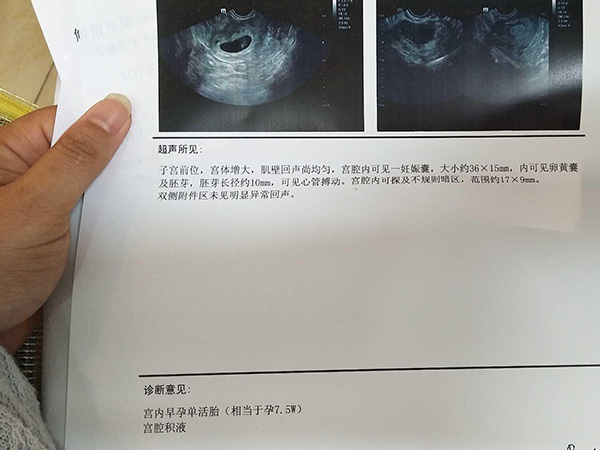 孕期宫腔积液的检查报告