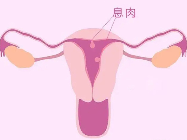 子宫内膜息肉会造成经前出血