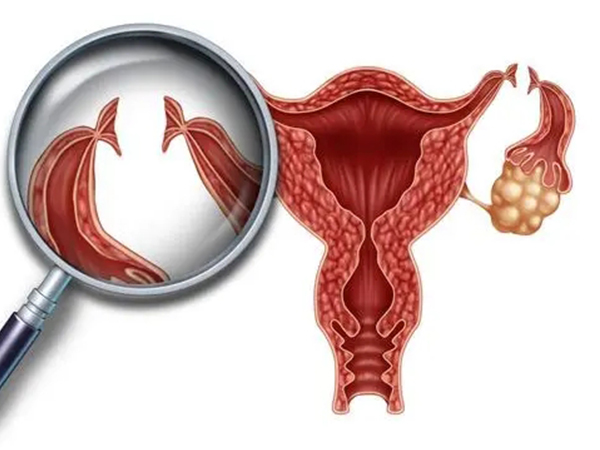 输卵管切除后可以通过试管怀孕