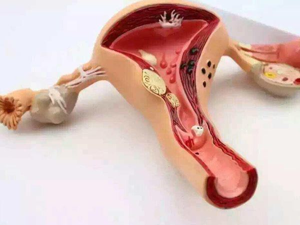 子宫腺肌症会影响胚胎着床