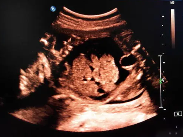 染色体异常会引发胎儿腹腔积液增多