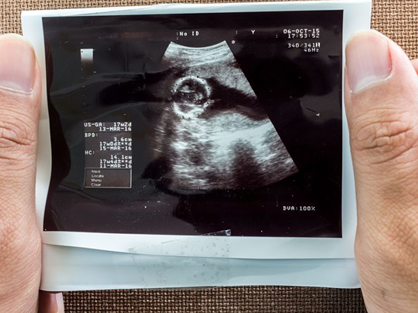 孕8周没有胎心很可能是胎停育了