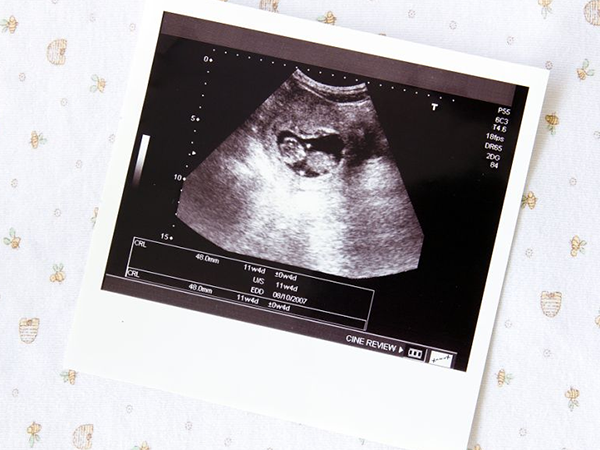 胚胎是否存活要看有没有胎心