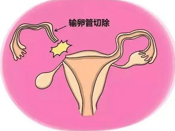 切除一侧输卵管后自然受孕率下降
