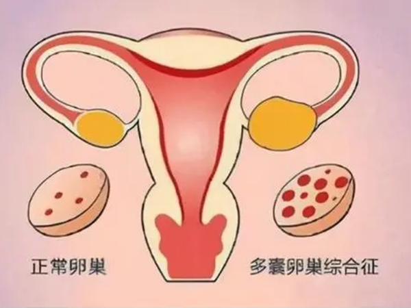 多囊卵巢综合征患者要避免辛辣食物