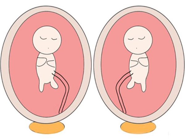 异卵双生不共用一个孕囊