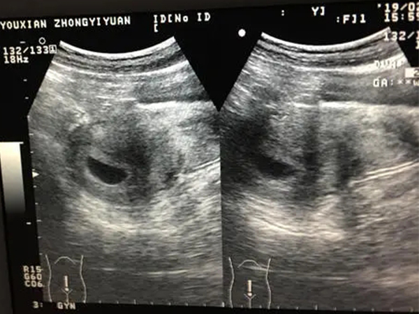 双胎男孩孕囊图片图片
