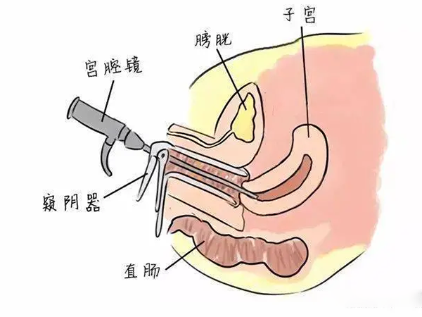 检查宫颈的步骤图片图片