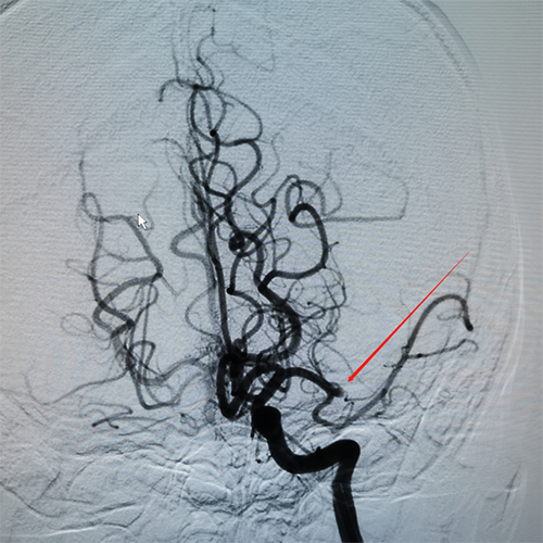 全脑血管造影术,可见左侧大脑中动脉闭塞