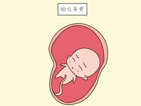 臀位的宝宝脑部不一定畸形