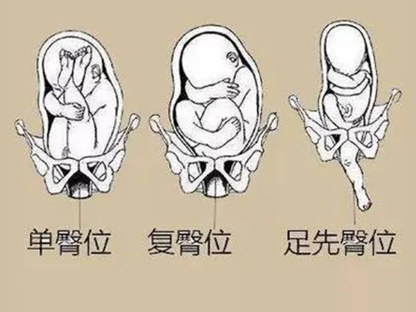 胎儿臀位是异常胎位的一种