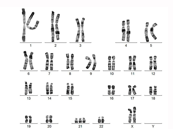 染色体18的检查数值与胎儿性别无关