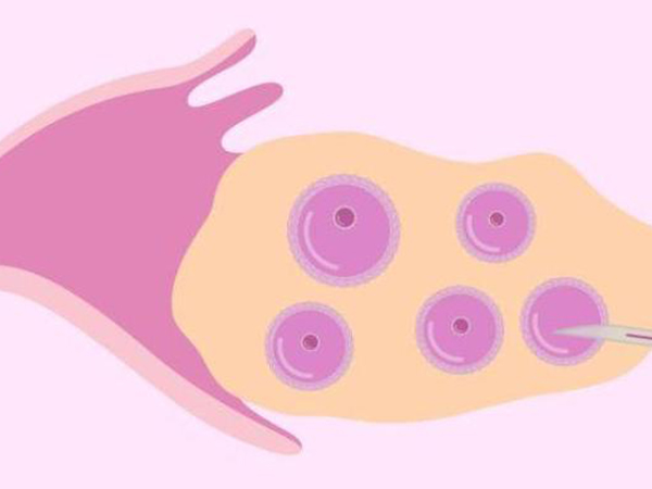 取卵后可能会导致卵巢扭转