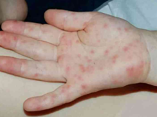 发烧引起的病毒疹图片图片