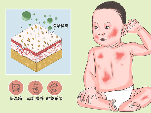 火棉胶婴儿是一种遗传病