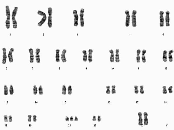 16三体属于染色体异常