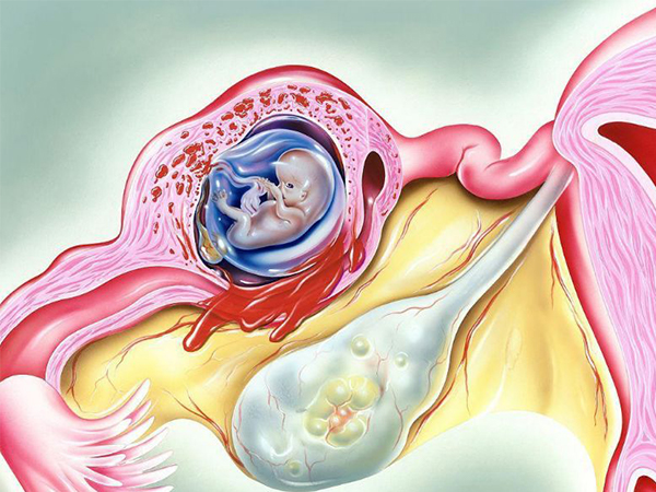 宫外孕即胚胎着床位置异常的情况